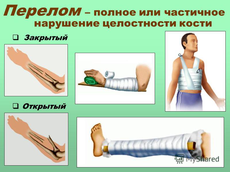 План конспект первая помощь при переломах и вывихах