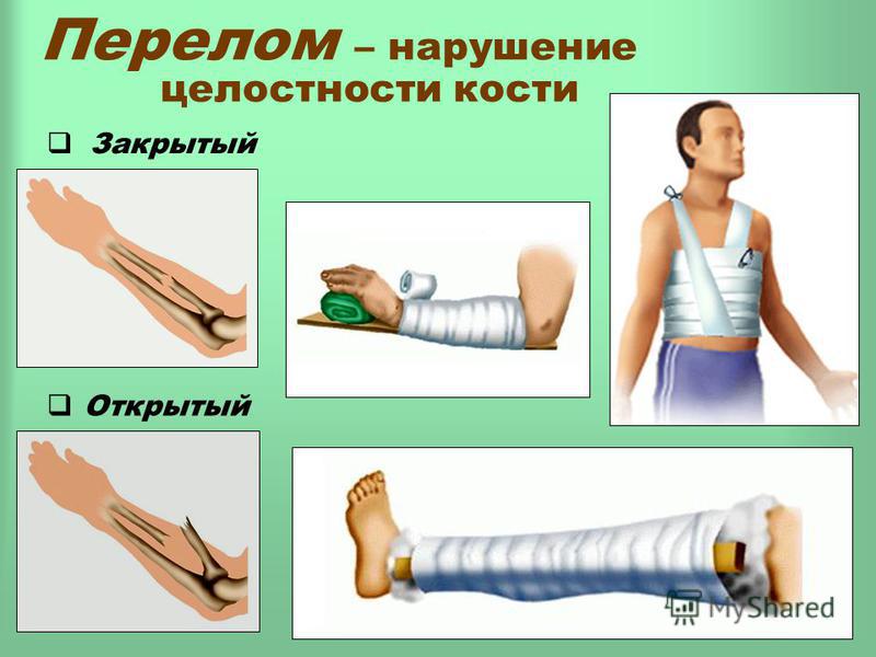 Первая помощь при ушибах и переломах презентация